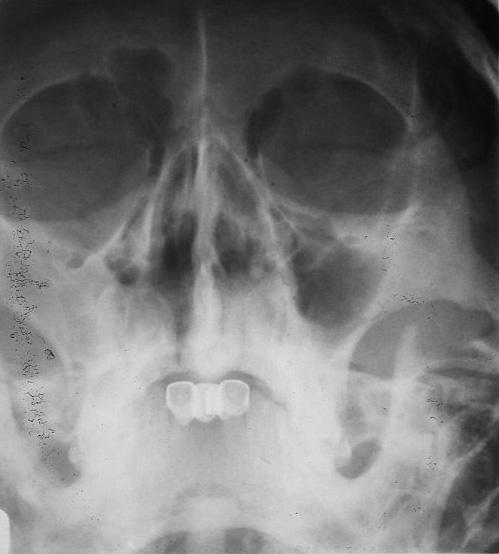 한편자기공명영상뇌검사 (Brain MRI) 에서는그결과가좌측소뇌구조물에선양낭포성악성종양 (Adenoid cystic carcinoma) 으로확진되어뇌수술을받고방사선치료와항암화학요법약물치료를시행해야되는상태였다. 그러나해면정맥동까지침범한우측부비동의악성종양발생부위는그범위가너무광범위해수술은불가능하고방사선치료와항암화학요법이가능한치료법이었다.