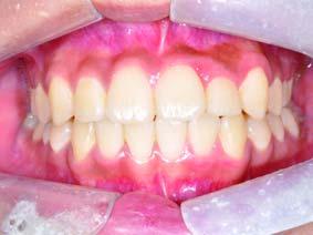 교정치료와자가지방이식후, 치아배열, 교합, 안면비대칭이개선되었다 (Figure 9).