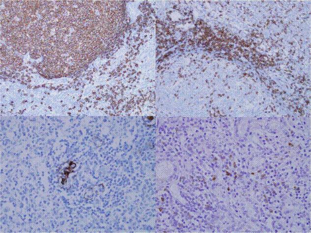 - 김영욱외 5 인. 항면역글로불린 G4 염색양성의 Mikulicz 병 - C D Figure 3. () Immunohistochemical stain for CD 20 showed diffuse strong positive in the germinal center ( 100).