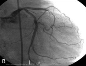 -Min Woong Kim, et al : A case of clopidogrel induced neutropenia - Figure 1. (A) Left coronary angiogram with a right anterior oblique caudal view.
