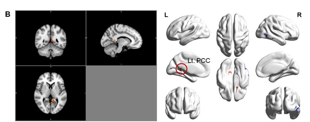 disorder patients (A) Right OFC: k=60; t=3.76179; uncorrected p (peak)= 0.