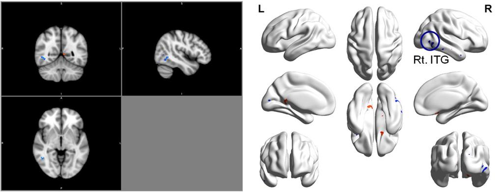 Figure 4. Areas of which gray matter were larger in treatment non-responding patients than in treatment responding obsessive-compulsive disorder patients Right ITG: k=51; t=3.