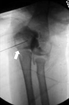개월이상지난환자들의경우섬유성반흔조직의유착으로내과골편에부착된정상연부조직을온전히보존하면서박리하기가용이하지않았다.