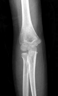 Anteroposterior radiograph taken months after surgery showed an irregular margin of medial side of the distal humerus with an ossification center of medial epicondyle. Fig. 6.