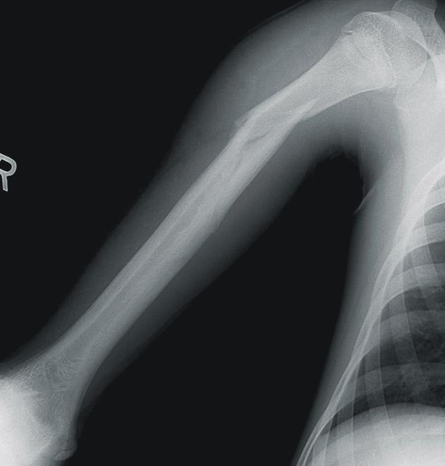 439 팔씨름에 의해 발생한 상완골 간부 및 내 상과 골절 단순 방사선 사진상 골절선의 특징은 상완골 내측 피질 골에 서 골절선이 시작되어 나선형으로 이어지는 양상이었으며, 이 중