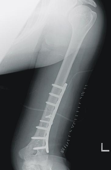 man. (A, B) Initial radiograph shows humerus shaft spiral fracture with butterfly fragment.