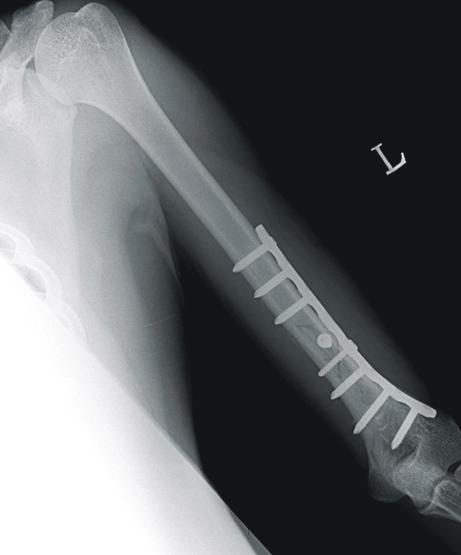 (D) Follow-up radiograph 12 month after operation shows good fracture healing without complication.