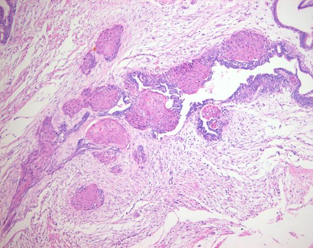 Eun Jung Cha, et al Extensive Squamosu Metaplasia Mimicking Squamous Cell Carcinoma in Fibroadenoma 57 주변