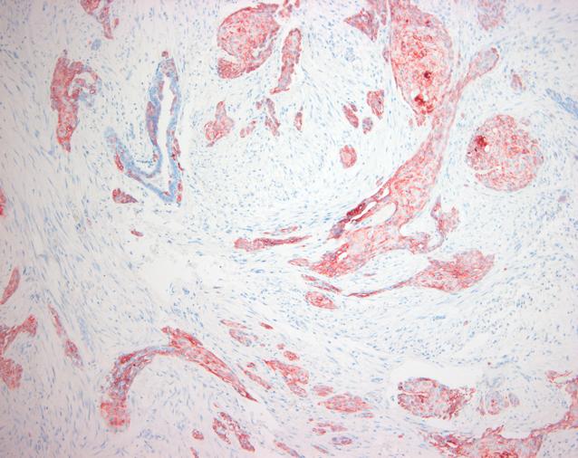로 인해 낱개 세포로 떨어져 침윤성 암종을 시사하는 소견 그러나 국소적으로 4개까지 증가되어 관찰되었으나 비정 Fig. 3.