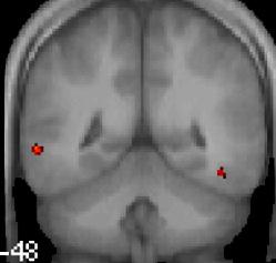 Brain regions with significant differences in gray