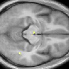 right inferior frontal gyrus(c).