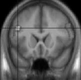 pathological gambling group(n= 1). Results are superimposed on an average gray matter template and shown at p<.