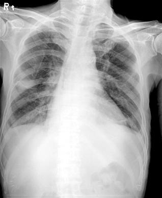 심부전환자에서수혈관련급성폐손상의진단 Fig. 1. Chest radiographs. (A) Chest PA, 6 hours before blood. (B) Chest AP, 4 hours after the time the patient developed dyspnea after, showing bilateral lung infiltrates.