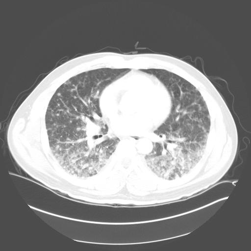 - 건강한사람에서발병한수두와동반된수두폐렴 1 예 - Fig. 2. HRCT scan on hospital day #2 shows multiple less than 1cm sized nodules and consolidation in both lung fields.