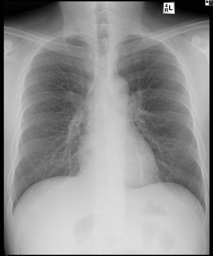 2일간 acyclovir 로치료한다음열은나지않았으며새로이발생하는피부병변은없었다. 그러나두피, 얼굴, 몸통, 사지에가피는증가되었다. 입원 6 후호흡곤란은호전되었으며대기중동맥혈가스분석에서 ph 7.438, - PaCO 2 42.8 mmhg, PaO 2 73 mmhg, HCO 3 29.3 mmol/l, 산소포화도 95% 였다.