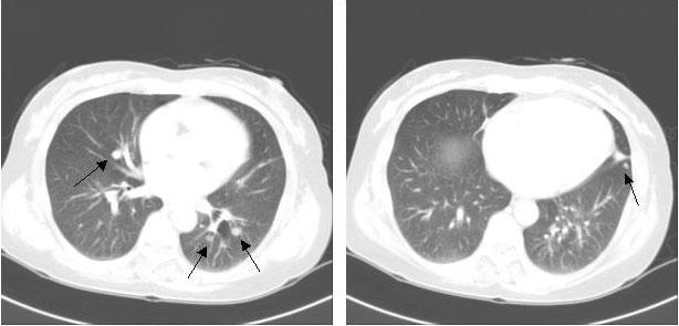 Tuberculosis and Respiratory Diseases Vol. 60. No. 1, Jan. 2006 Figure 1. CT scan reveals multiple nodular opacities on both lung fields. Figure 2.