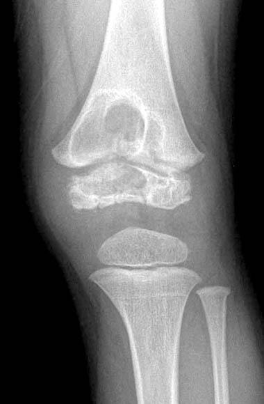Well healing status of osteomyelitis without an evidence of recurrence. Fig. 4. Case 2.