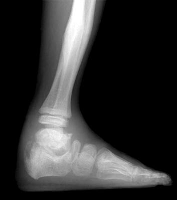 swelling. Plain radiographs of the right (A, C) and left ankle (B, D).