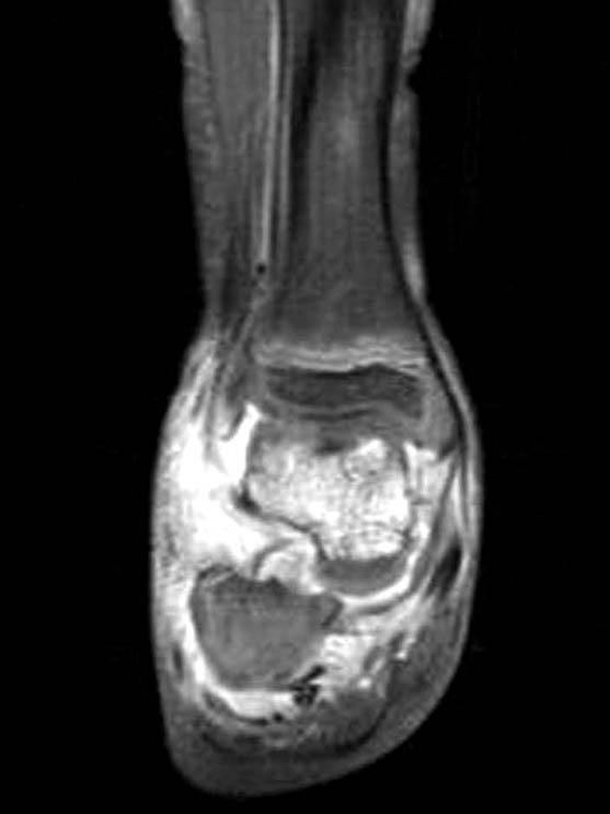 정상면역체계를가진소아에서발생한비결핵항산성균에의한골수염 689 Fig. 5. Case 2.
