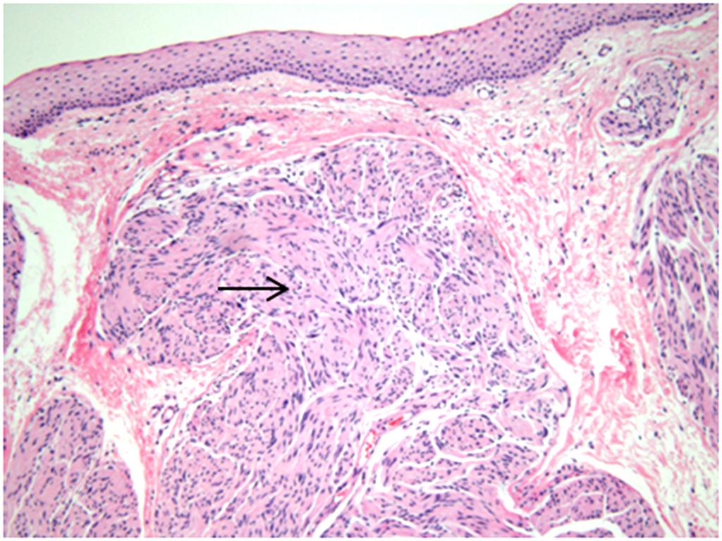 - 대한안과학회지 2015년 제 56 권 제 2 호 - Figure 3. Histologic feature and immunohistochemical staining of the conjunctival neuroma.