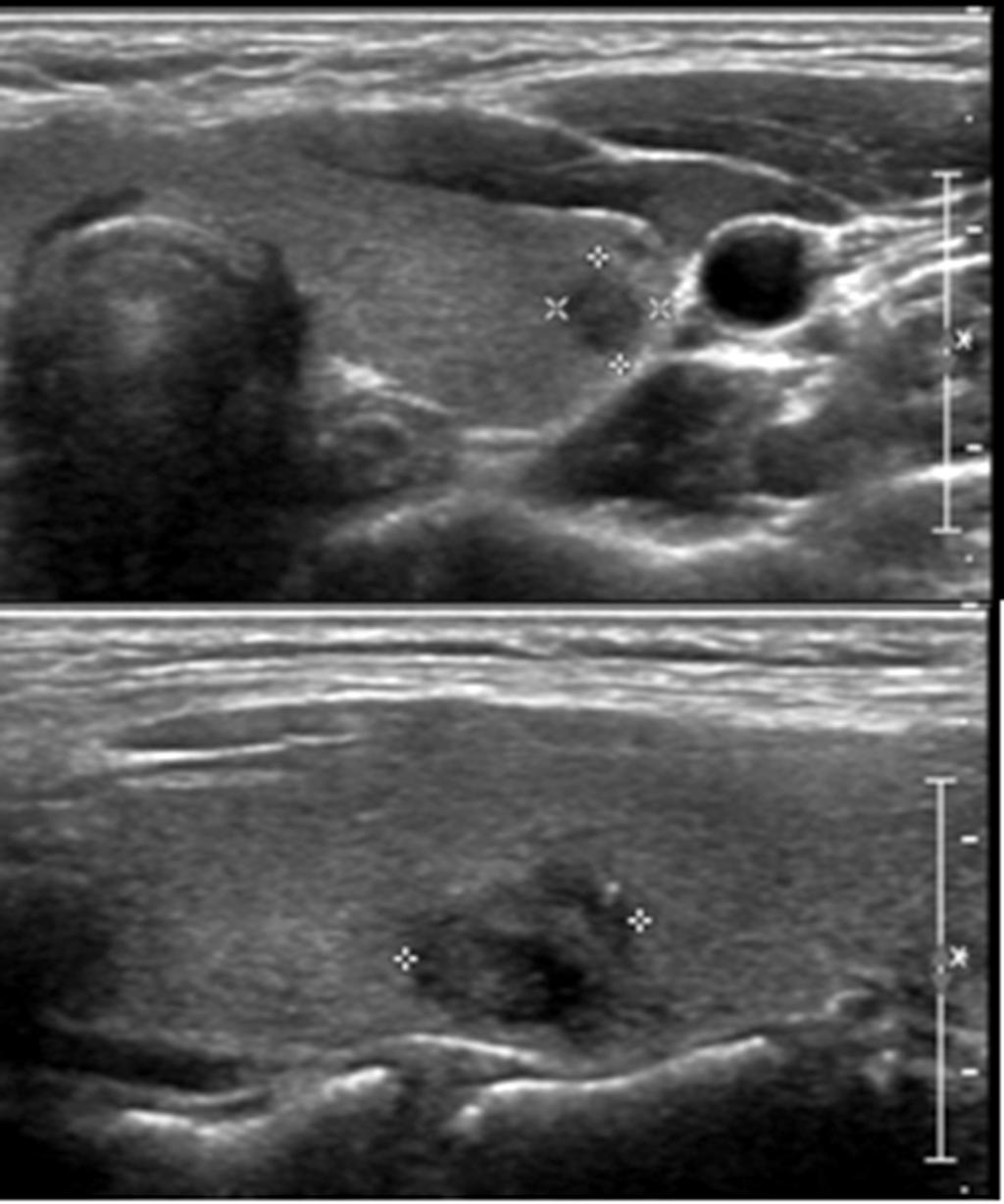 Thyroid ultrsonography shows 0.5 cm-sized irregular marked hypoechogenic nodule (arrow) at the left mid-pole () and 1.