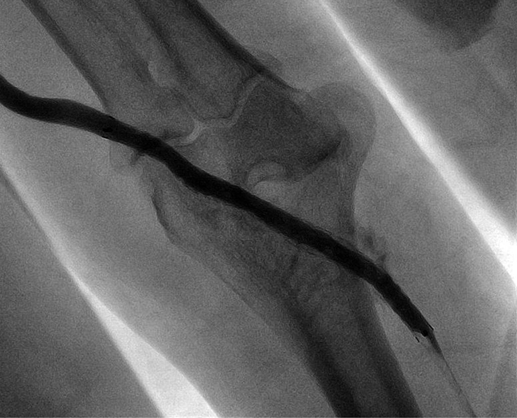 윤여창외 A B C D Fig. 1. A 72-year-old man with dysfunctional arteriovenous graft. A. Venogram after aspiration thrombectomy reveals the severe stenosis at the venous anastomosis (arrows) and drainage vein (arrowheads).