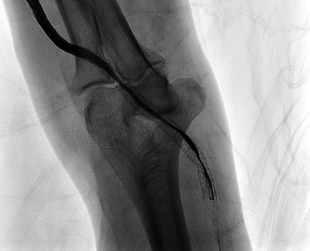 Venogram after a 100 x 8 mm nitinol stent placement and balloon dilatation shows full expansion of the stent deployed across the elbow joint. D.