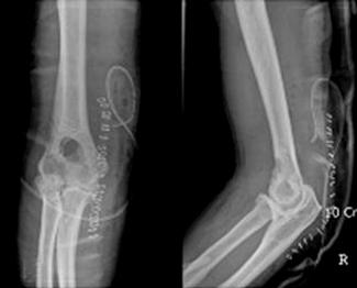 (B) Postoperative radiograph of the same patient after an ulnohumeral arthroplasty procedure: Osteophytes and loose bodies were removed and the olecranon fossa was fenestrated.