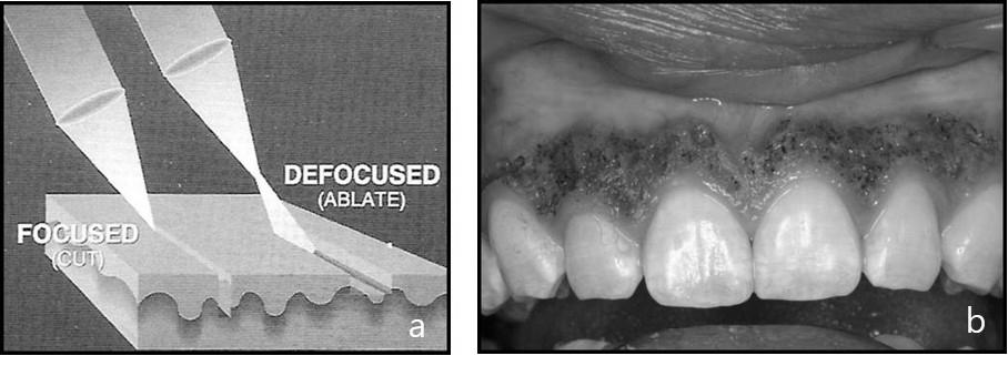 그림 1. Cutting technique 의예 a. 생검 b. 치관연장술 2-2 Ablation technique 레이저로병소나조직의제거를 칠을벗겨내는 방식으로시행하는것이다.