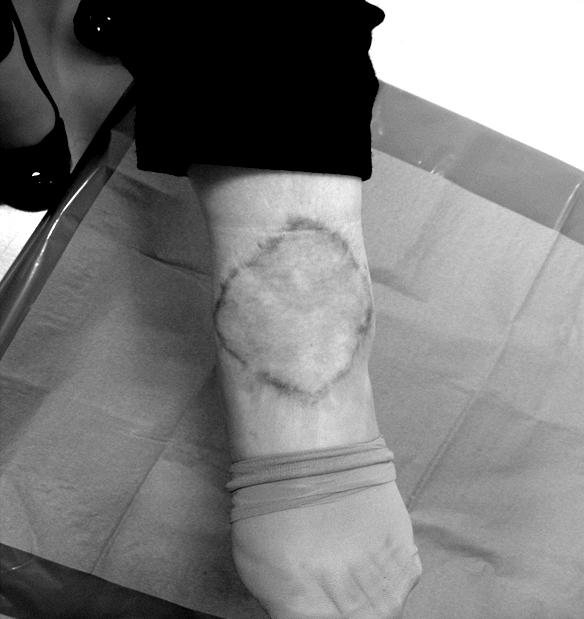 (Right) Postoperative 16 months view shows release of burn scar contracture and excellent external contouring. Fig. 3. Case 3.
