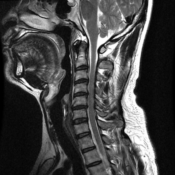 379 경추후궁확장성형술의합병증 Figure 4. (A) Preoperative T2 magnetic r e s o n a n c e i m a g i n g ( M R I ) s h o w s multisegmental cord compression.