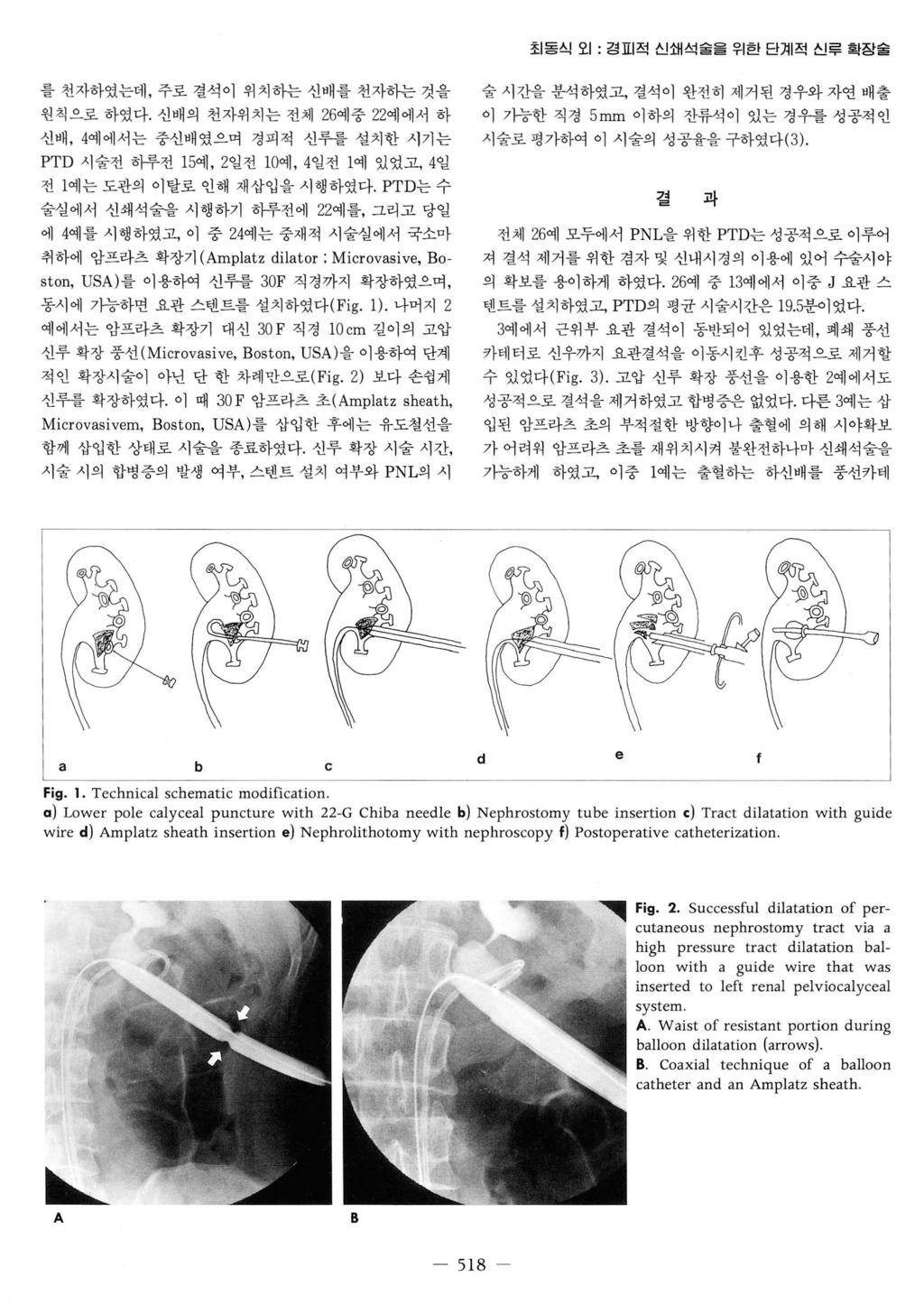 최동신오 1: 경표 적신쇄석술을위한단계적신루확장술 를천자하였는데, 주로결석이위치하는신배를천자하는것을 원칙으로하였다. 신배의천자위치는전체 26 예중 22 예에서하 신배, 4 예에서는중신배였으며경피적신루를설치한시기는 PTD 시술전하루전 1 5 예, 2 일전 10 예, 4 일전 1 예있었고, 4 일 전 l 예는도관의이탈로인해재삽입을시행하였다.