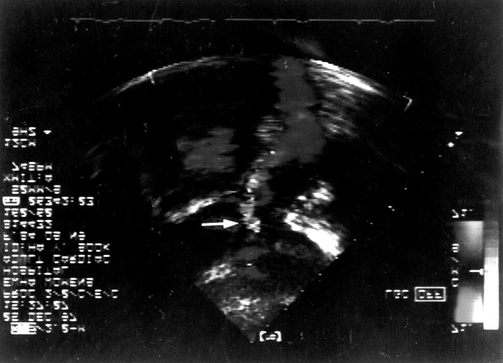 coronary artery aneurysm. 고 계산된 Qp/Qs는 2.6 1로 현저한 좌우단락의 소견 을 보였다. 대동맥 조영술에서 조영제가 대동맥으로부 Fig. 3.
