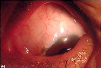 while trabeculectomy and cataract surgery without collagen matrix and use of 5-FU in the