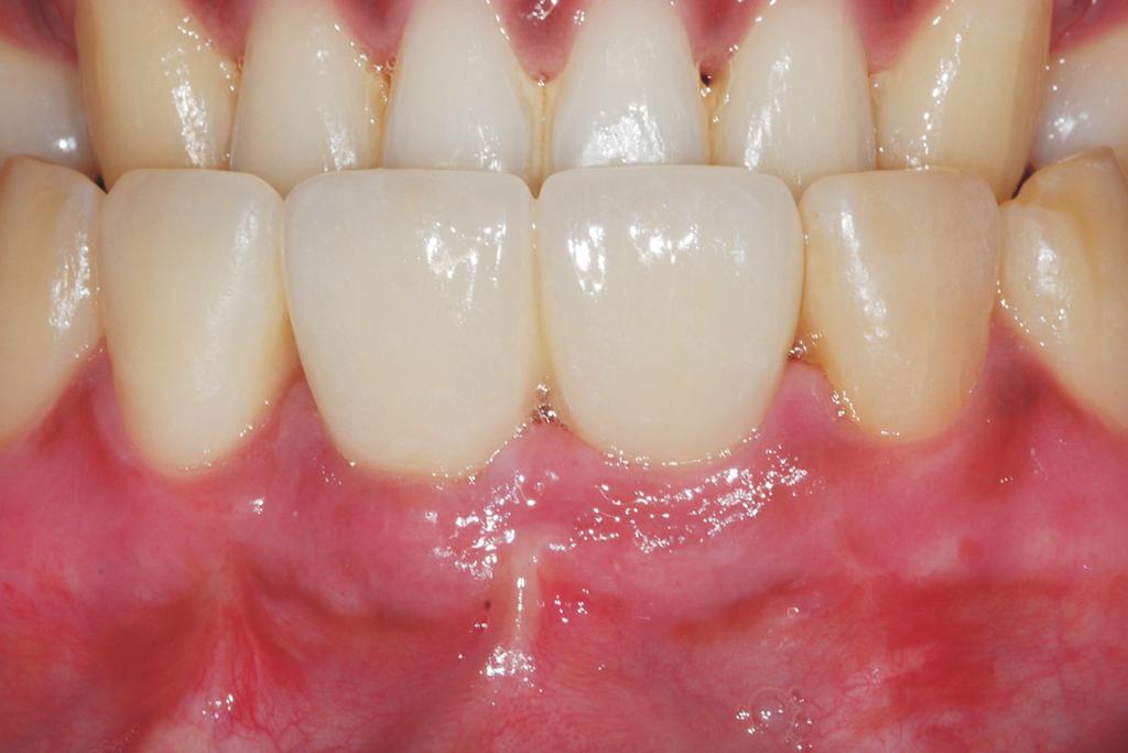 Case Report Fig. 10. One month check-up after gingival plastic surgery and bleaching.