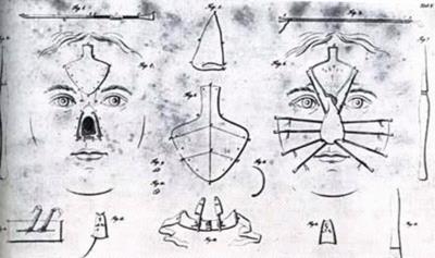 III. 미용성형수술시장의성장 1. 미용성형수술의역사 최초의성형수술은기원전 8년경인도에서시작최초의미용성형은클레오파트라 기록에남아있는인류최초의성형수술은기원전 8년경인도에서시행됐다.