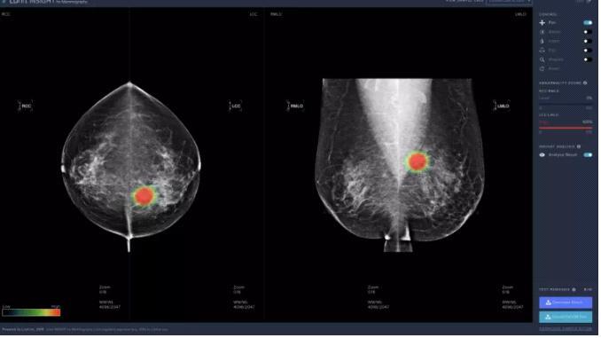 년유방촬영술을위한인공지능소프트웨어루닛인사이트 (Lunit INSIGHT for Mammography) 를공개 - 본인공지능소프트웨어를통해 97%