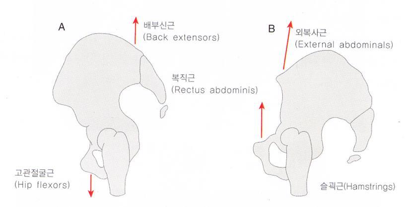 골반의앞쪽경사 허리엉치각 (Lumbosacral angle) 이란수평면과 S1 상단부분이이루는각. 정상성인의허리엉치각은 30 도이며, 이각의증가는허리뼈앞굽음증이된다.