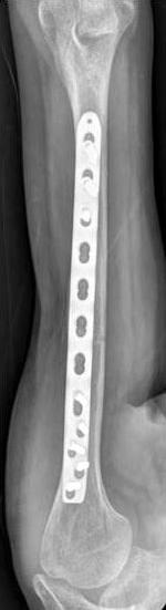 방사선적골유합은 OPEN군에서골절선이사라질때, MIPO군에서 4면의피질골면중 3면에서골절면을가교하는가골형성이보일때를골유합시기로판단하였고임상적으로는동통없이관절운동이가능할때를골유합으로판단하였다.