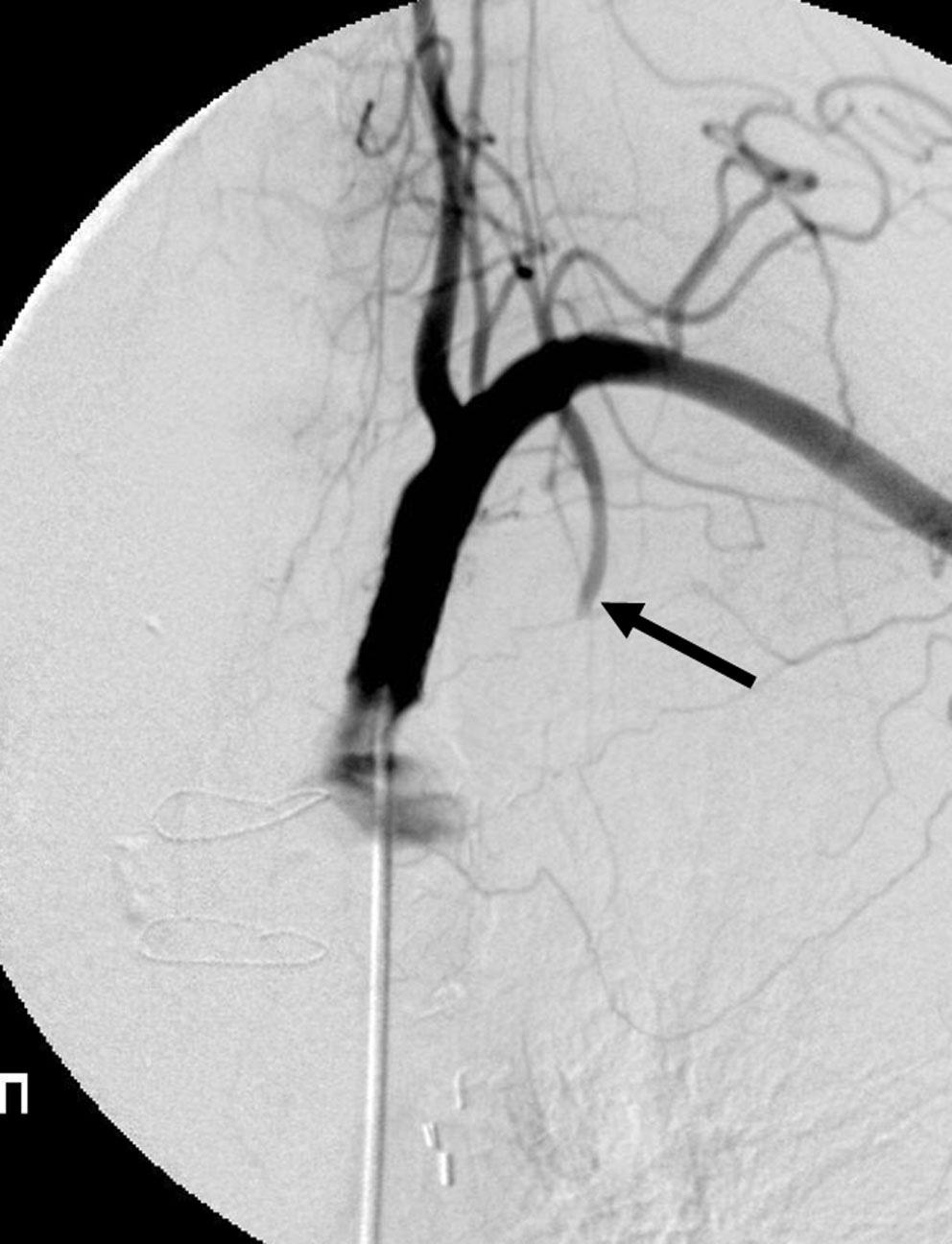 . rteriogram obtained after placement of a stent shows improved subclavian stenosis, but stagnation of contrast media in the proximal left internal