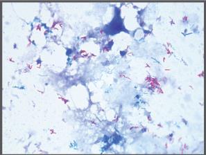 직접검사법 : Microscopy and stain AFB stain 결핵균등의항산균은일반적인염색이되지않음.