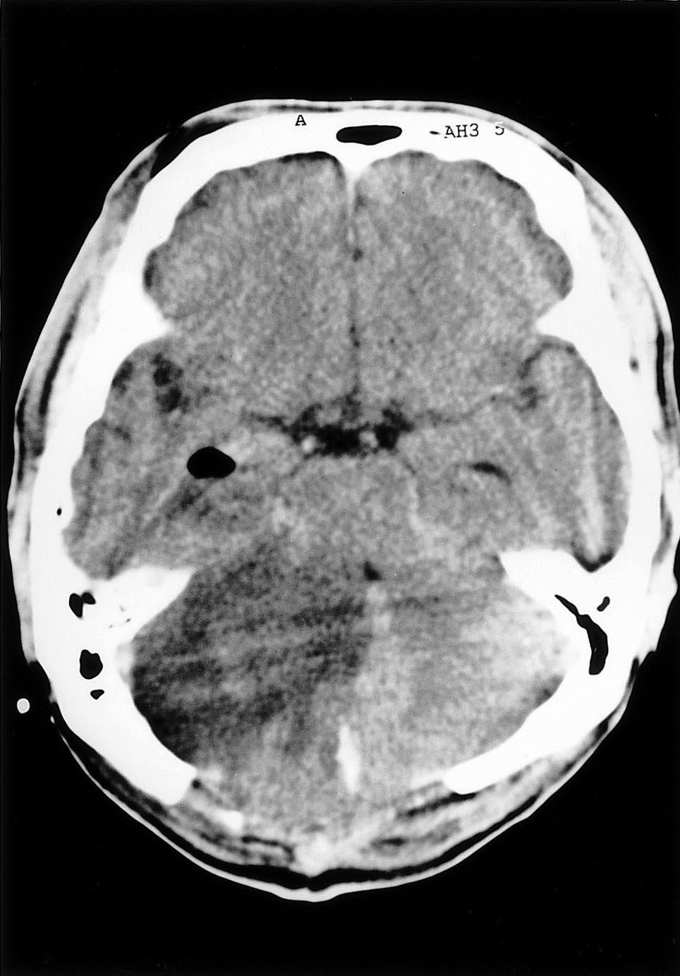 There is low density lesion in right cerebellar hemisphere with mass effect shifting midline to the left showing ischemic infarcion area. Figure 5.