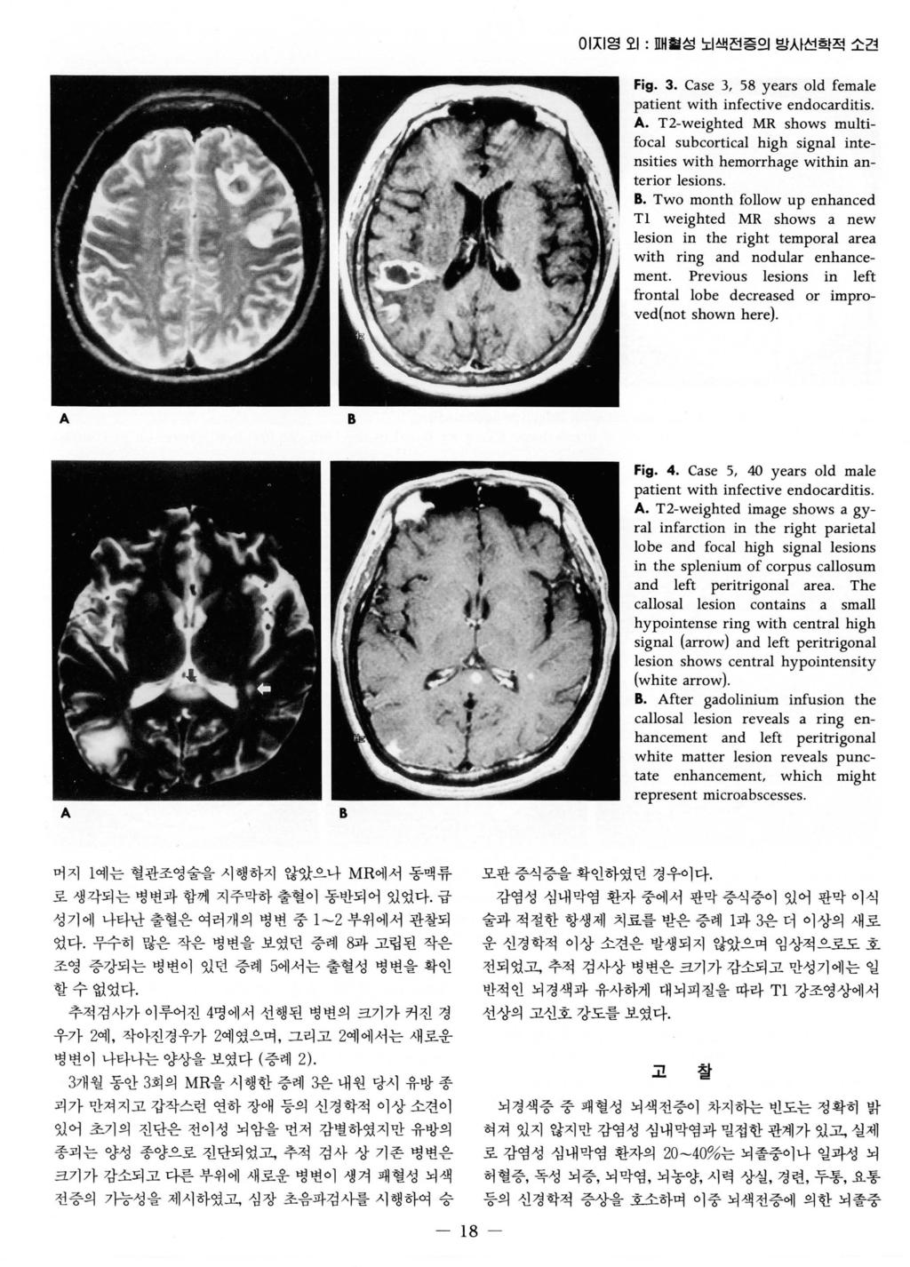 이지영오 1: 매혈성뇌색전증의밤시선학적소견 Fig. 3. Case 3, 58 years old female patient with infective endocarditis. A.