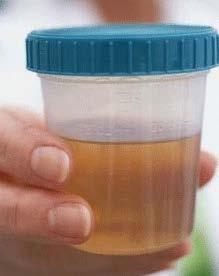 6) 요당검사 (urine test