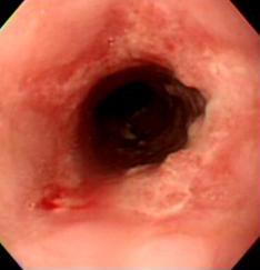 lumen of the esophagus is slightly narrow. (C) Under NBI, there was no mucosal lesion. 고, 이에 치료진과 환자는 내시경을 이용한 광역동치료를 실시 하기로 하였다.
