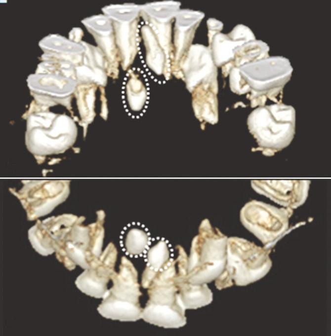 Panoramic(a) and periapical view(b) at first visit. Two inverted conical mesiodens are found in 6-year old boy.
