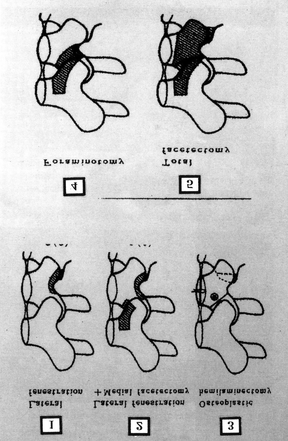 극돌기 절제 및 부분적 후궁 절제술을 이용한 추간공내 요추간판 탈출증의 수술적 치험 경(pedicle)의 내측 경계와 외측 경계사이를 말한다7). 적 안정성을 보존하면서 탈출된 수핵을 직시하에 제거하기 극외측 추간판 탈출증(extreme lateral disc herniation) 위하여 그동안 많은 수술방법들이 시도되어 왔다.