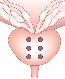 TRUS guided Biopsy Strategy (I) Directed biopsy TRUS and/or DRE Sextant biopsy technique Hodge KK et al, J Uro 1989.