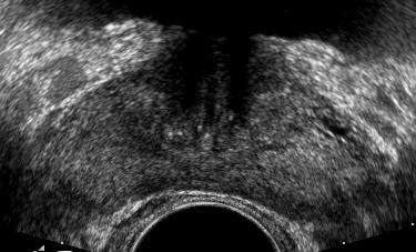 BPH TRUS: Normal Appearance Prostate Peripheral zone No clear