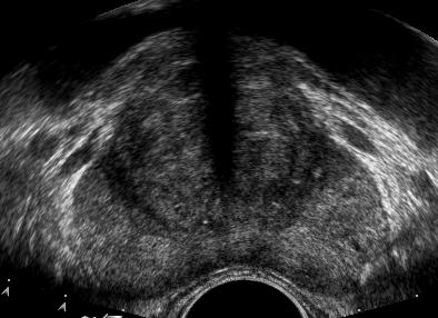 Transitional zone Coarse & slightly hypoechoic Increasing